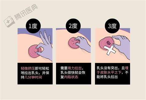 乳暈黑點|乳暈上有「小顆粒」正常嗎？乳暈顏色和別人不一樣？女孩到女人。